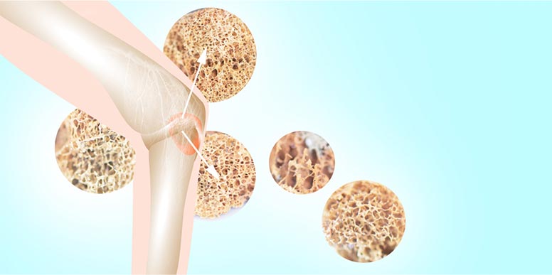 osteoporose uma doenca silenciosa que afeta os ossos